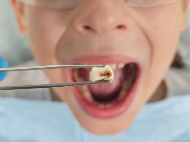 Best Pediatric Emergency Dentist in Athens, OH