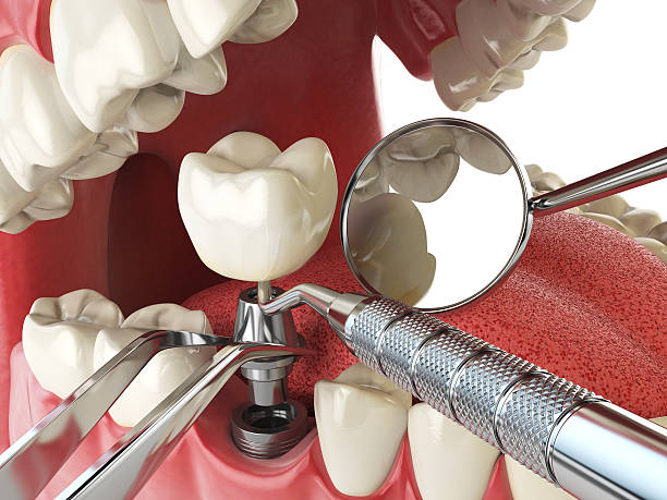 Best Emergency Dental Extractions in Athens, OH